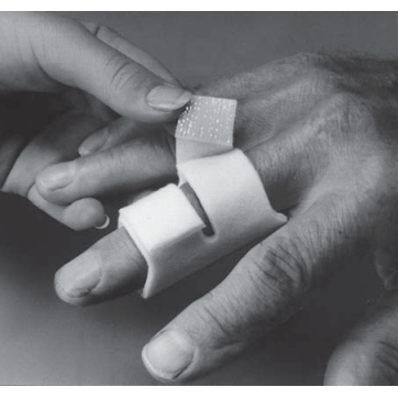 Almedic Finger Splint 